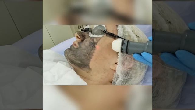 Карбоновый пилинг в Петербурге смотреть онлайн