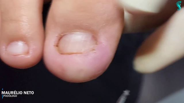 DEPOIS DE 3 EXTRAÇÕES A UNHA CONTINUA ENCRAVADA #podologomaurelio #ingrowntoenail смотреть онлайн