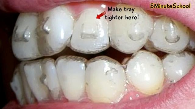 Invisalign Attachments And Buttons | How Do They Work? - Explained In 4 Minutes!