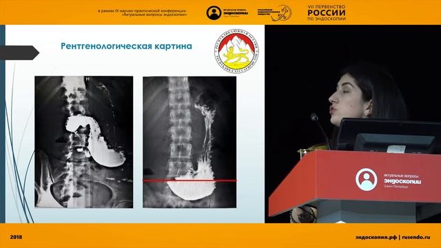 ЯЗВЕННЫЙ ДУОДЕНИТ …. ИЛИ ТУБЕРКУЛЕЗ ДВЕНАДЦАТИПЕРСТНОЙ КИШКИ?