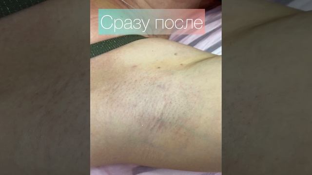 Электроэпиляция ⚡️ подмышек смотреть онлайн