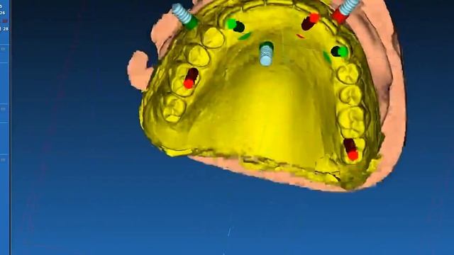 Точная имплантация без разрезов десны смотреть онлайн