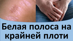 Белая полоса на крайней плоти