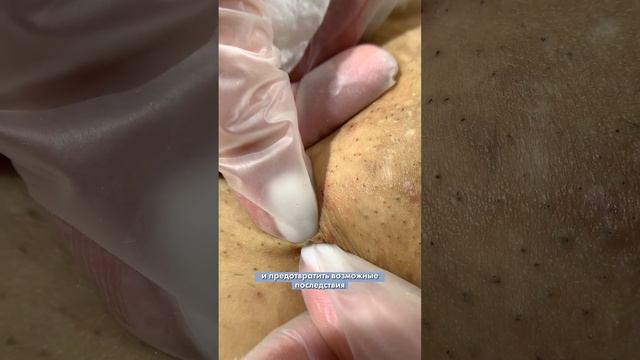 Вросшие волосы #ЛазернаяЭпиляцияБишкек #ГладкоеБудущееРеально #ЛазерВсемогущий смотреть онлайн