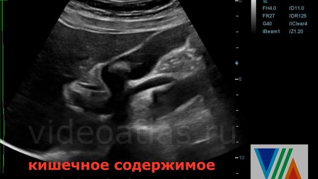 Камни ЖП. Петля кишки имитирует камень в ЖП. смотреть онлайн