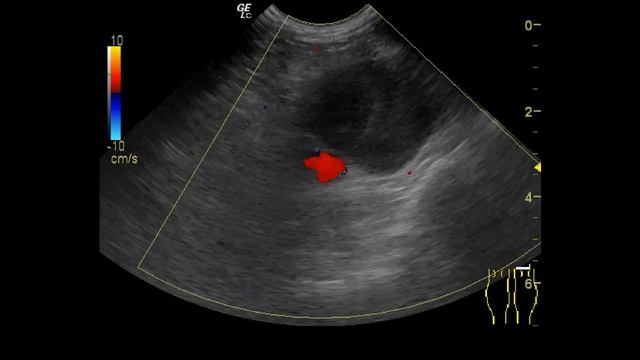 УЗИ при аневризме подколенной вены
