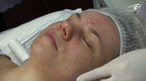 Биоревитализация обучение. Опасные зоны для инъекций.