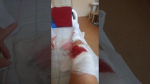 удаление штифта с большой берцовой кости