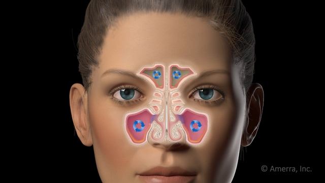 Functional endoscopic sinus surgery (FESS) - 3D animation смотреть онлайн