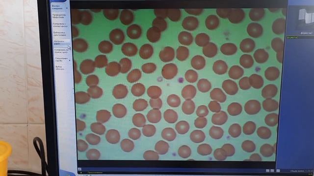 Подсчёт тромбоцитов по Фонио смотреть онлайн