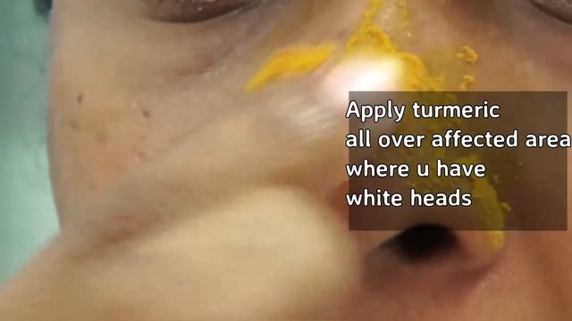 Turmeric to remove White heads on Nose| Starnaturalbeauties смотреть онлайн