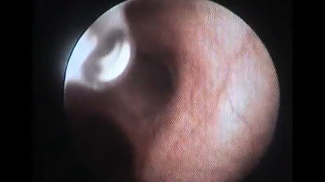 Клапанная бронхоблокация под местной анестезией смотреть онлайн