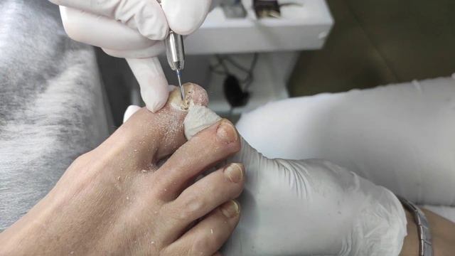 ОНИХОЛИЗИС? УДАЛИМ ЛЕГКО! смотреть онлайн