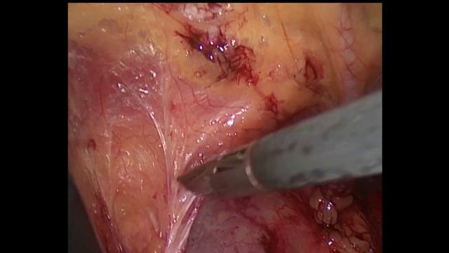 Laparoscopic TAPP/Лапароскопическая герниопластика