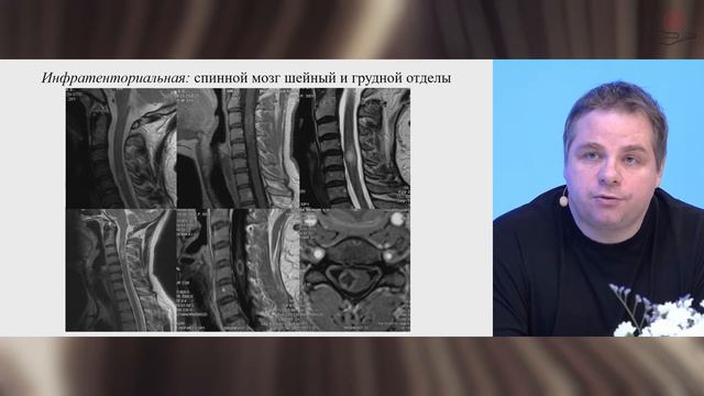 Нейровизуализация в дифференциальной диагностике демиелинизирующих заболеваний ЦНС.