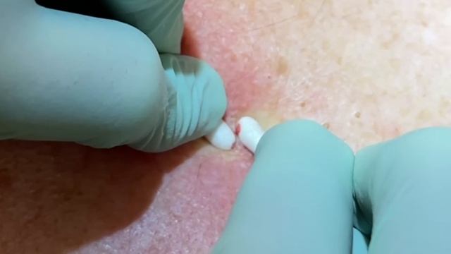 DPOW- The Cobra Blackhead. Back Blackhead Extractions With Ingrown Hairs. Follicular Cyst Pops.