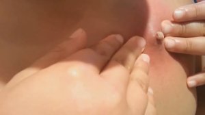 ТОП 10 самых отвратительных фурункулов ШОК!!!