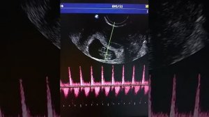 Сердцебиение малыша. УЗИ ранний срок беременности 8-9 недель