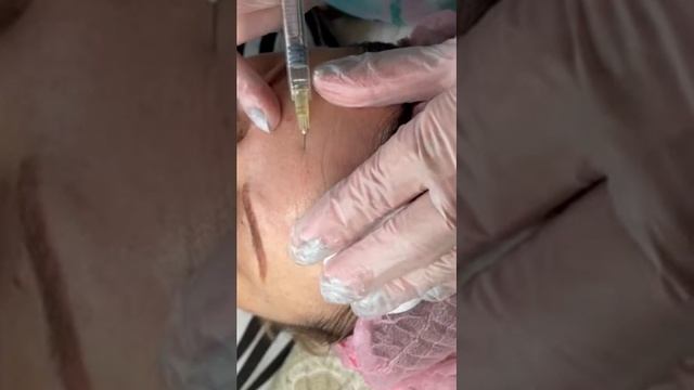 Бланшинг морщин лба. смотреть онлайн