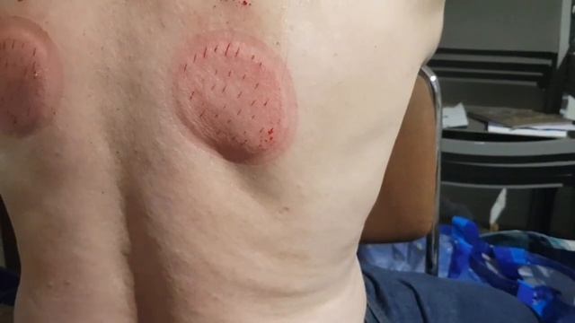 Хиджама для лечения почек.поясницы смотреть онлайн