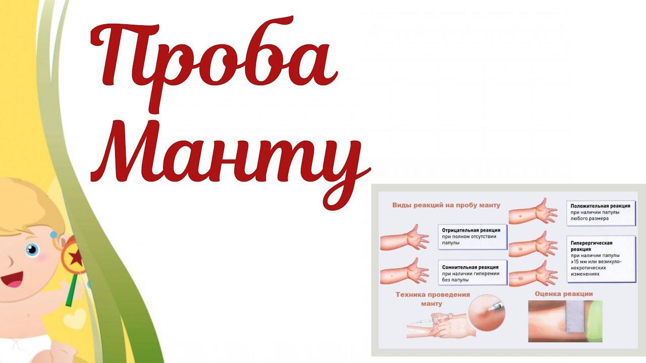 Проба Манту. Туберкулинодиагностика. Зачем нужна проба Манту! Зачем оценивают реакцию пробы Манту???