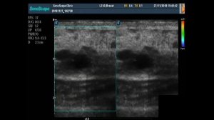 Эластография молочной железы. Мастер-класс.