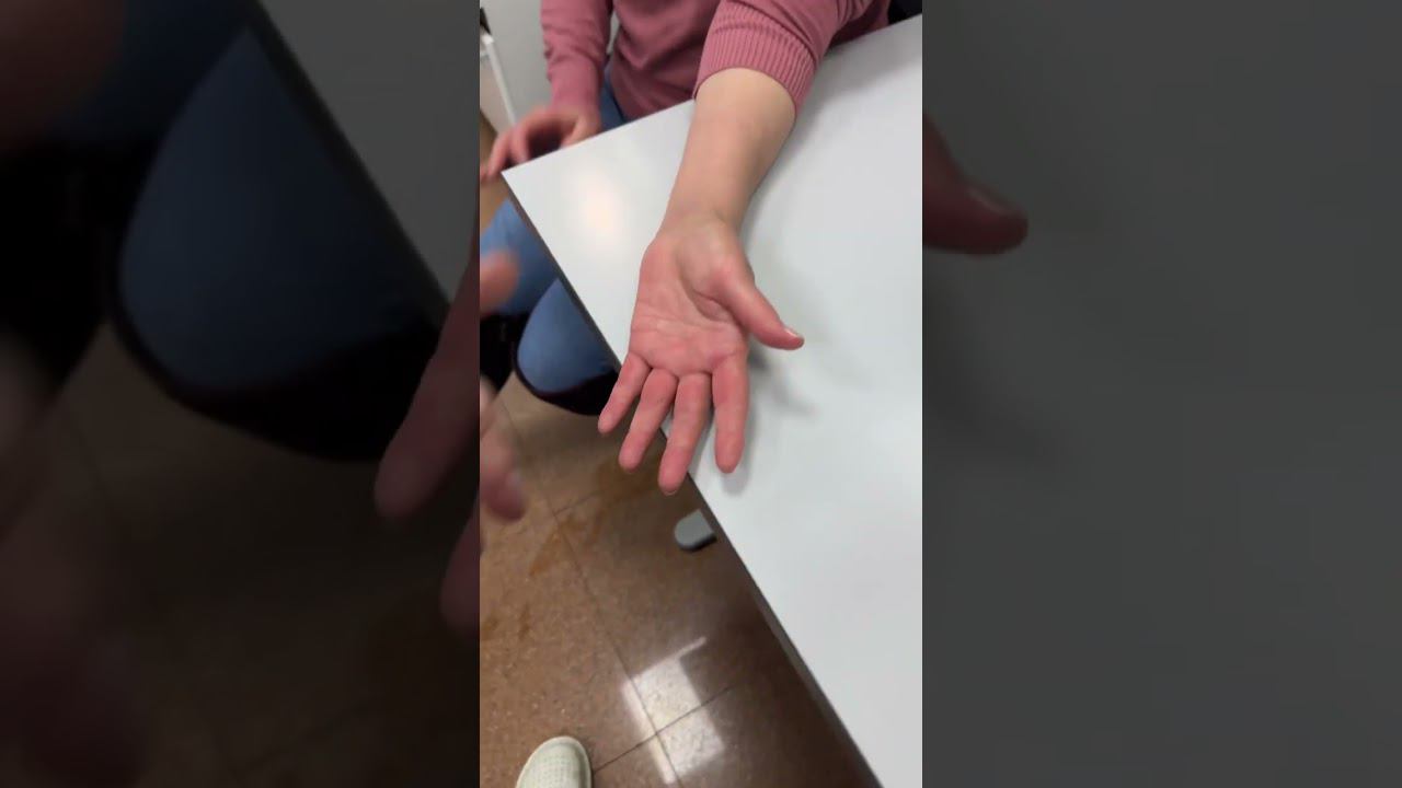 ПЕРЕЛОМ ЛУЧЕВОЙ КОСТИ СО СМЕЩЕНИЕМ | Результат восстановления | Доктор Юршин смотреть онлайн