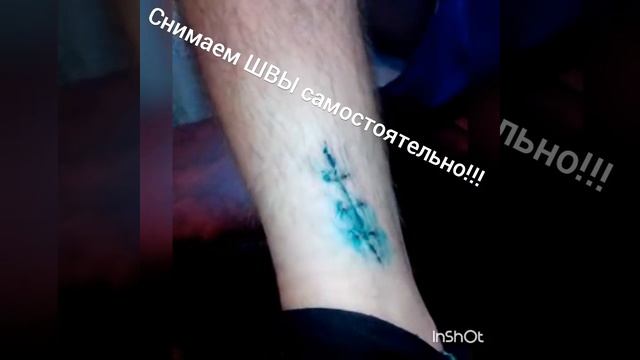 Как снять хирургический шов дома? смотреть онлайн