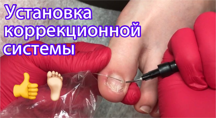 Установка коррекционной системы ???? смотреть онлайн