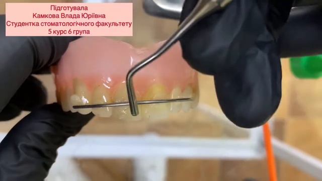 Шинування зубів смотреть онлайн