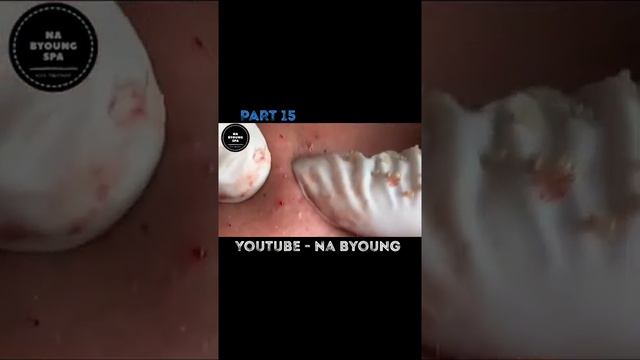 Blackheads Removal#25 смотреть онлайн