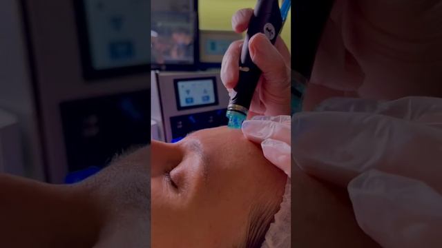 HYDRAFACIAL. Клиника VALLISTEP, Ярославль смотреть онлайн
