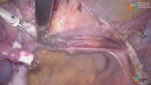 Лапароскопическая экстирпация матки с придатками