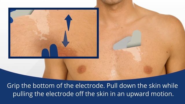 DMS-Service: How to Remove the myPatch®sl Holter Recorder and Adult Electrode смотреть онлайн