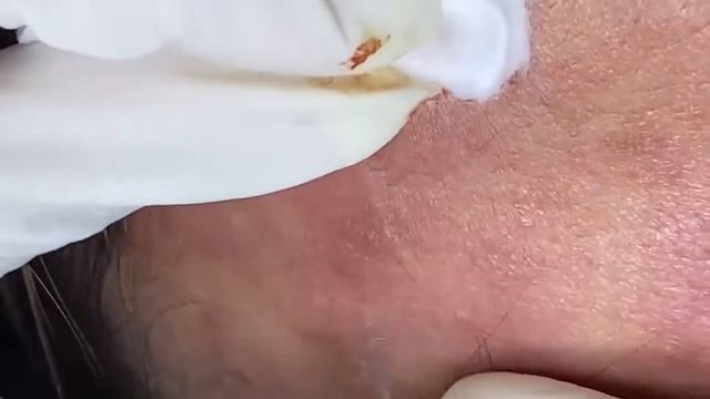 Relaxing Acne Treatment Acnes Treatment  74