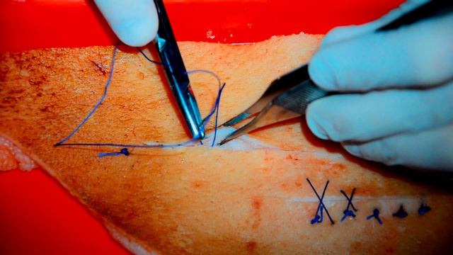 Cosmetic skin suture #2 Шов Холстеда (косметический шов), выпуск 16. 1080р! смотреть онлайн