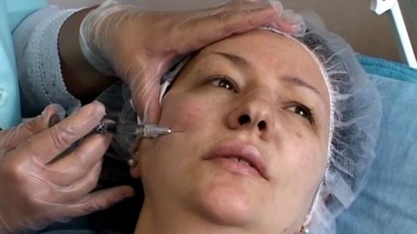 Мастер-класс "Коррекция различных анатомических зон монофазным гиалуроновым филлером Regenyal Idea"