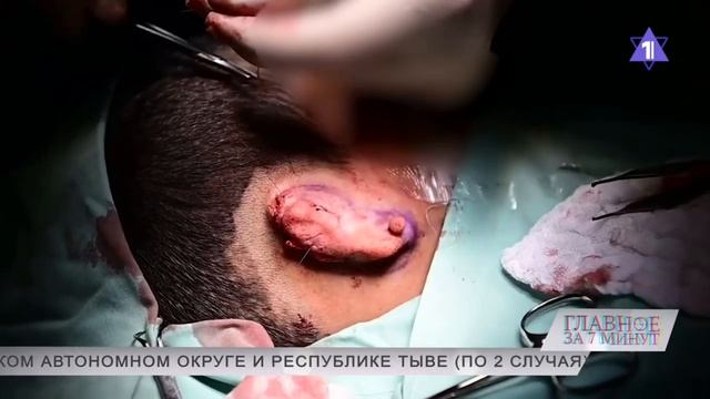 Израильские ученые «пришили» ребенку 3D-ухо смотреть онлайн