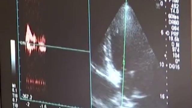 УЗИ - диагностика сосудов головы и шеи в Медицинском центре Панацея смотреть онлайн
