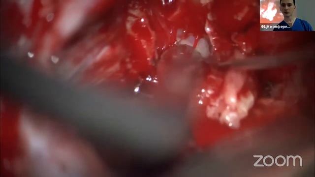 Neurosurgical Case Report (FCN, Tyumen, Russia) смотреть онлайн