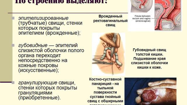 ЛЕКЦИЯ НЕКРОЗЫ, ГАНГРЕНА смотреть онлайн