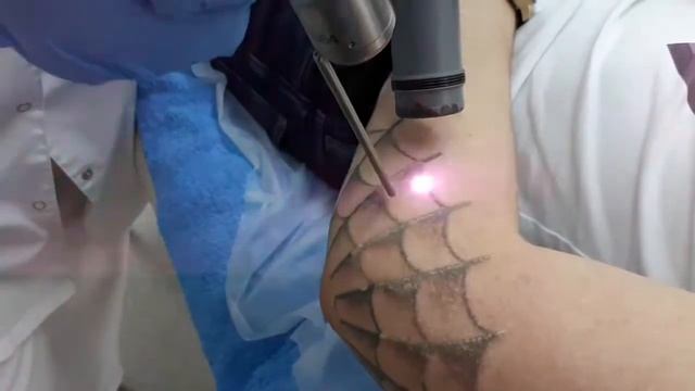 Удаление татуировок и перманентного макияжа смотреть онлайн