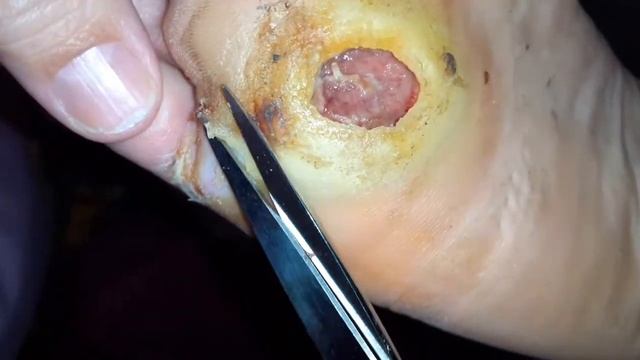 Диабетическая стопа. Что делать при деабетической стопе смотреть онлайн