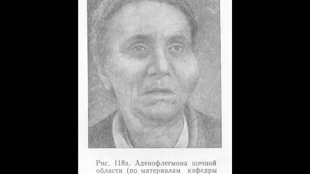 Обучающее видео. Аденофлегмона смотреть онлайн
