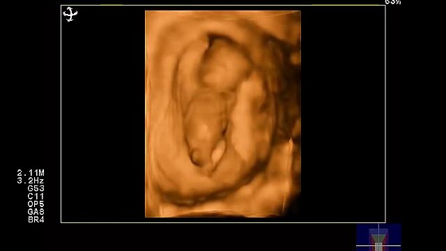 3 4 D плода 12 недель беременности смотреть онлайн