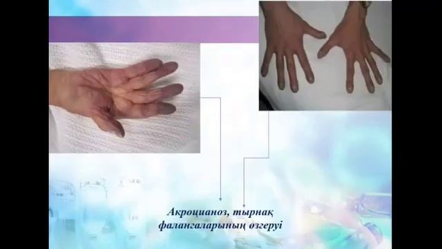 Туберкулез ауру кезіндегі мейіргерлік күтімді ұйымдастыру смотреть онлайн