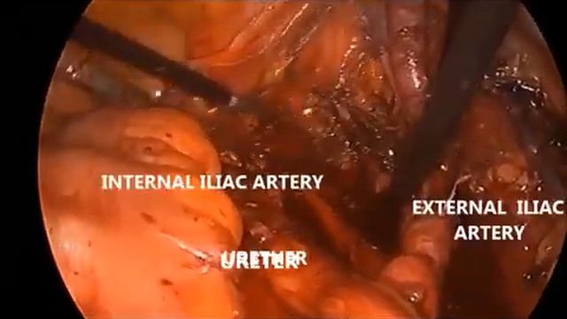 17 127URO Laparoscopic Salvage Pelvic Lymph Node Dissection in Recurrent Prostate Cancer: Manag... смотреть онлайн