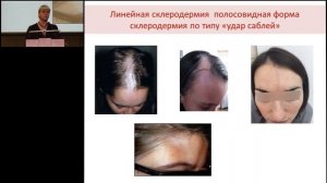 18.02.2017 - Очаговая склеродермия в практике дерматолога и педиатра