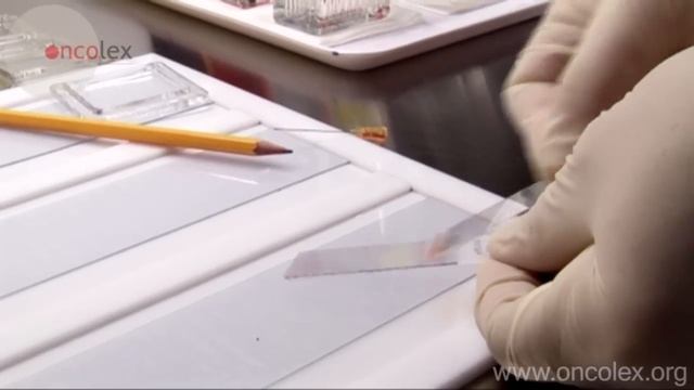 Abdominal fine needle biopsy; ultrasound-guided needle biopsy in the abdomen смотреть онлайн