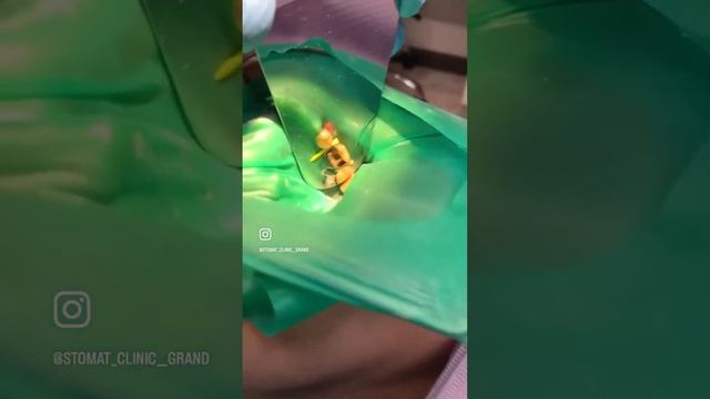 Установка пломбы пломбирование зуба Стомат Клиника Grand Днепр +380664179190